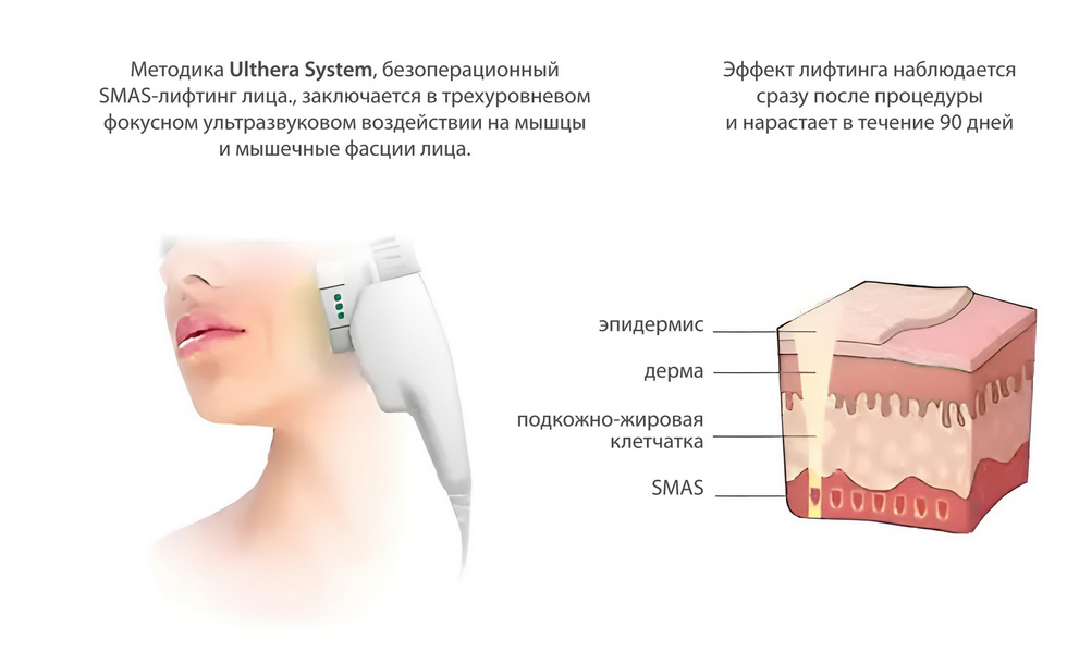 Ультразвуковой SMAS-лифтинг Ulthera System (Альтера Систем)