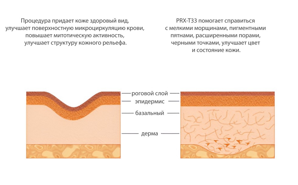 PRX-T33 терапия