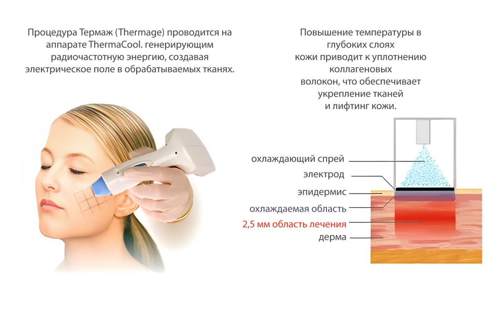 Термаж - Thermage