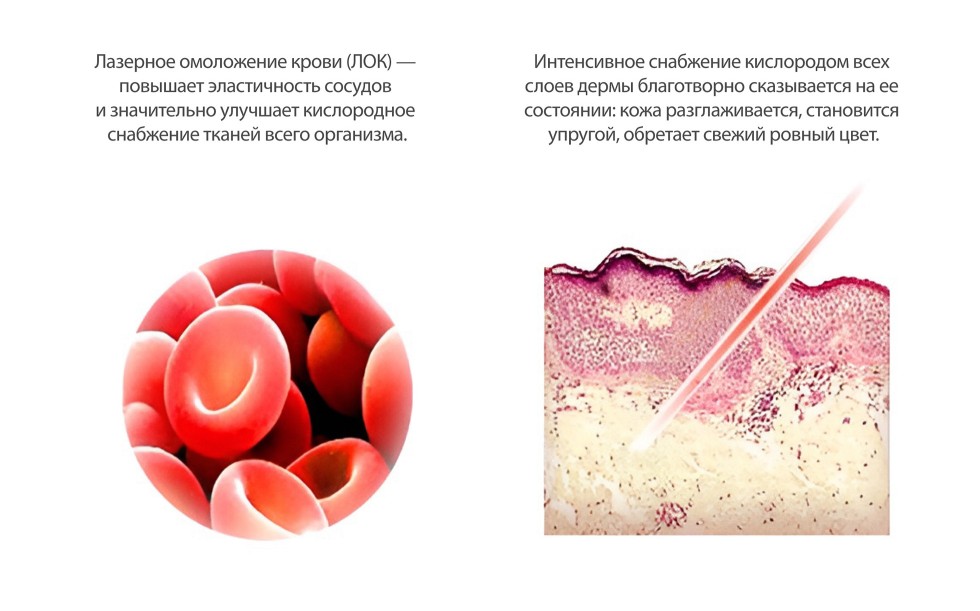 Лазерное омоложение крови