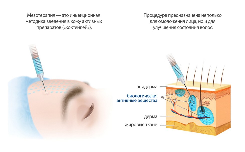 Процедура инъекционной мезотерапии для кожи на лице