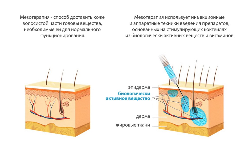 Процедура мезотерапии для лечения волос