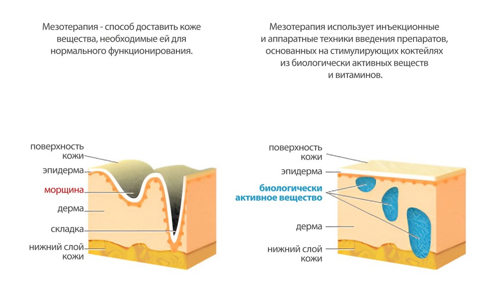 Процедура инъекционной мезотерапии для тела и от целлюлита