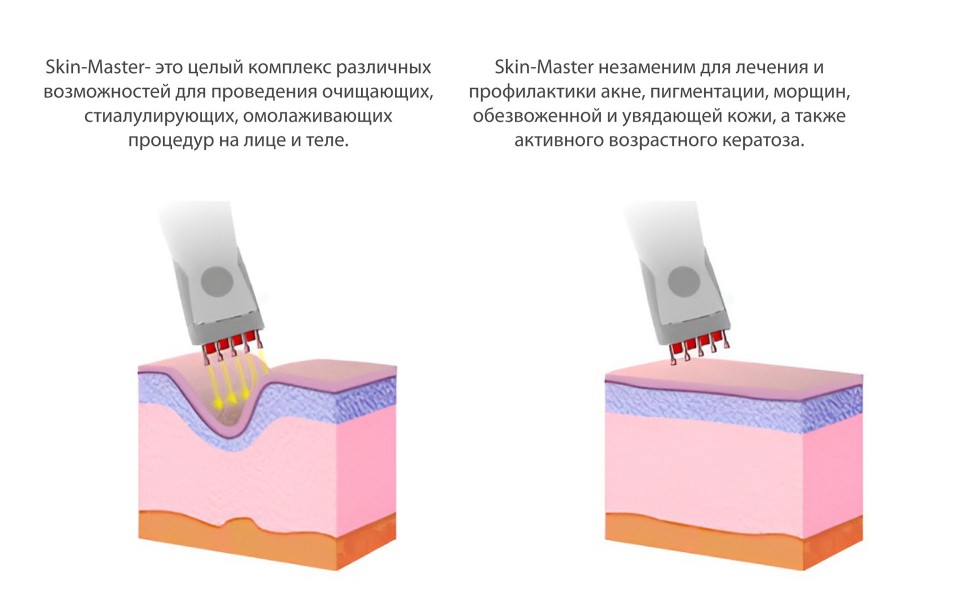 Аппаратная ультразвуковая чистка лица