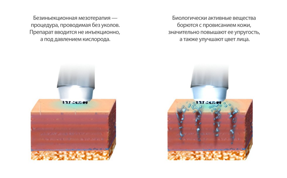 Процедура безинъекционной мезотерапии (метод без уколов)