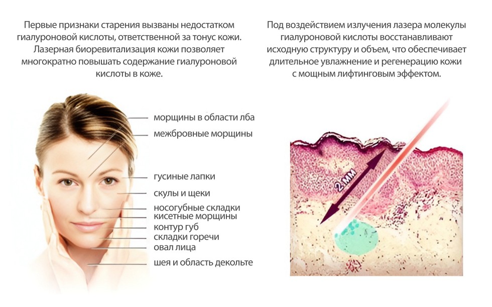 Процедура биоревитализации лица (инъекции гиалуроновой кислотой)