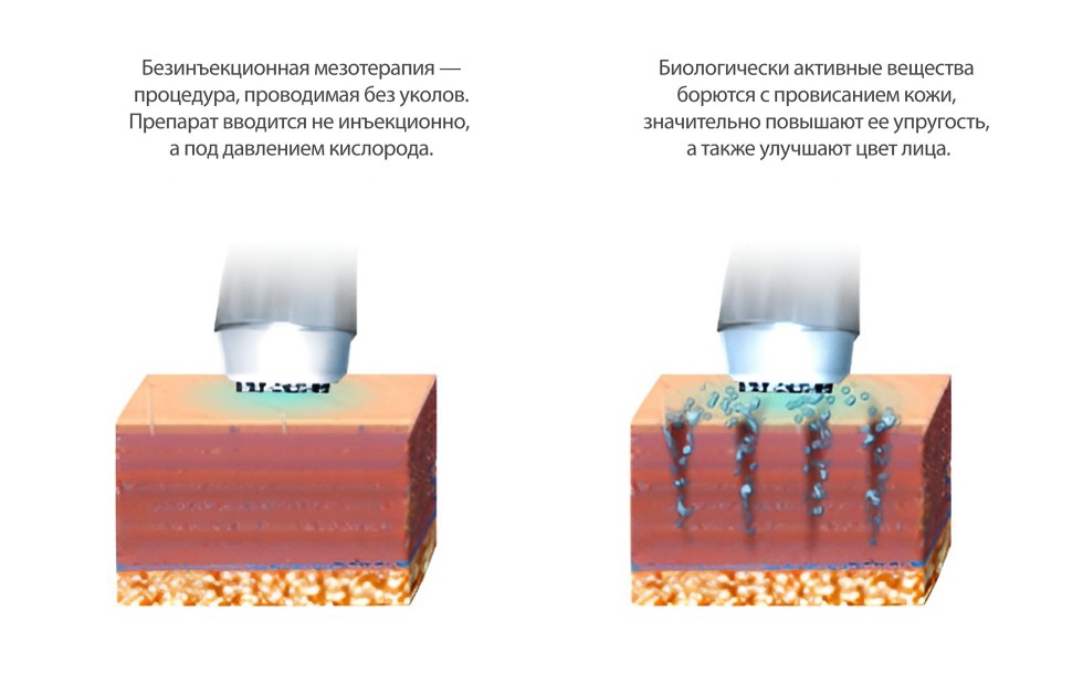 Ультразвуковая терапия