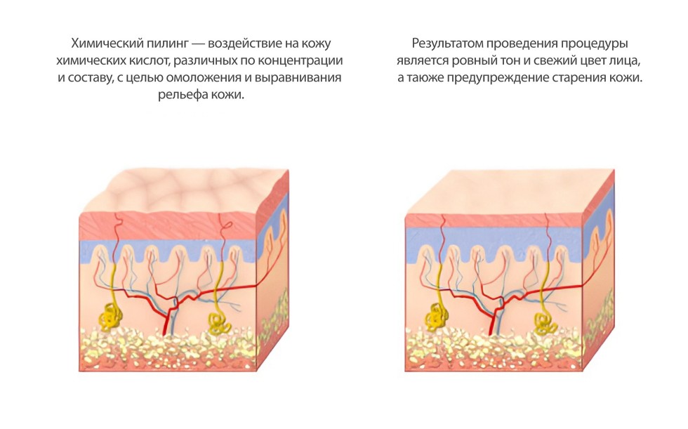 Химический пилинг