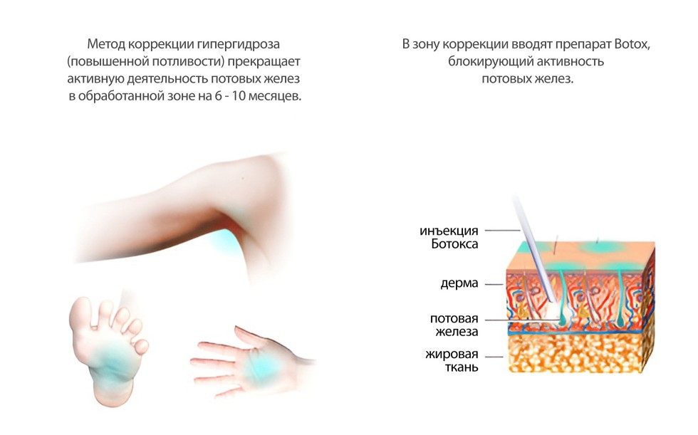 Лечение гипергидроза