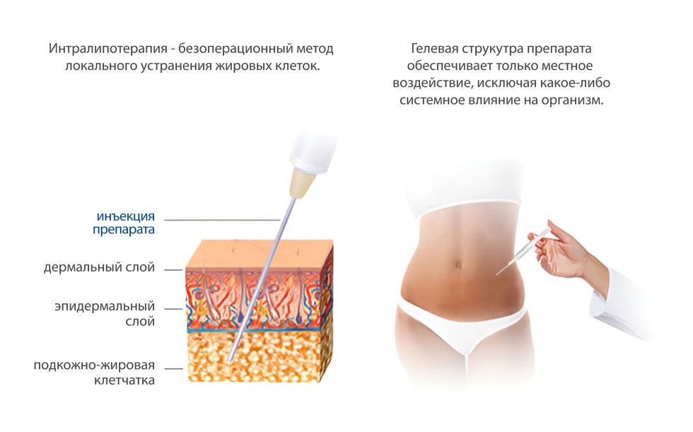 Процедура интралипотерапии (инъекционная липосакция препаратом Акваликс)