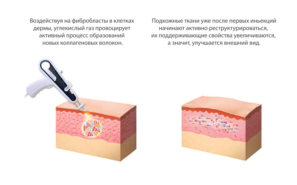 Карбокситерапия