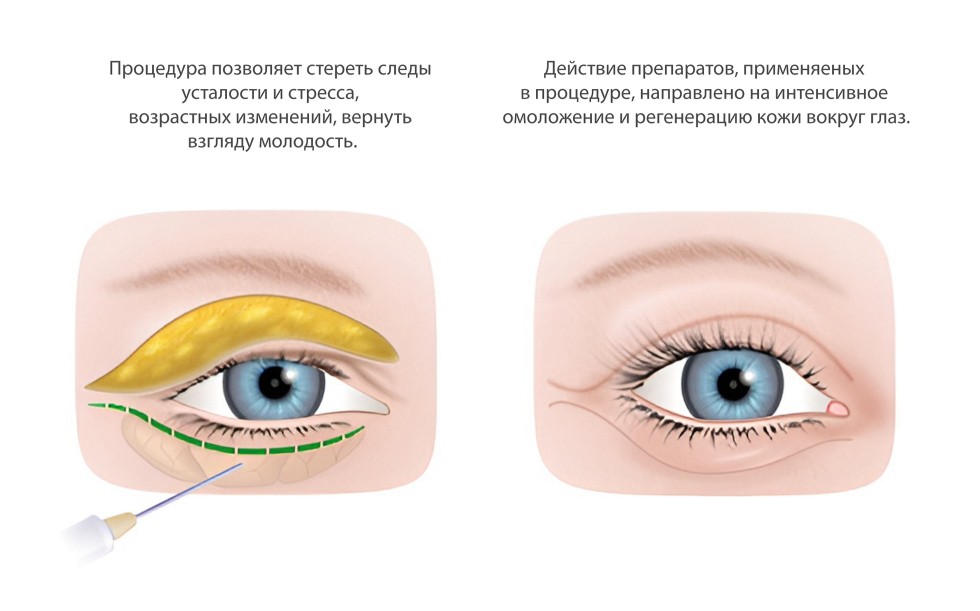Блефаропластика верхних и нижних век