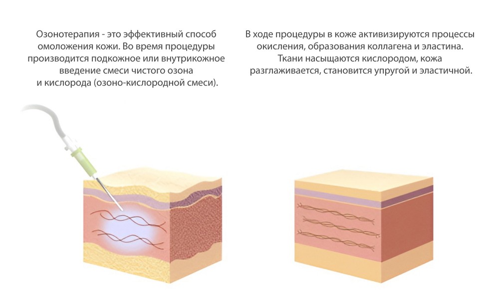 Озонотерапия