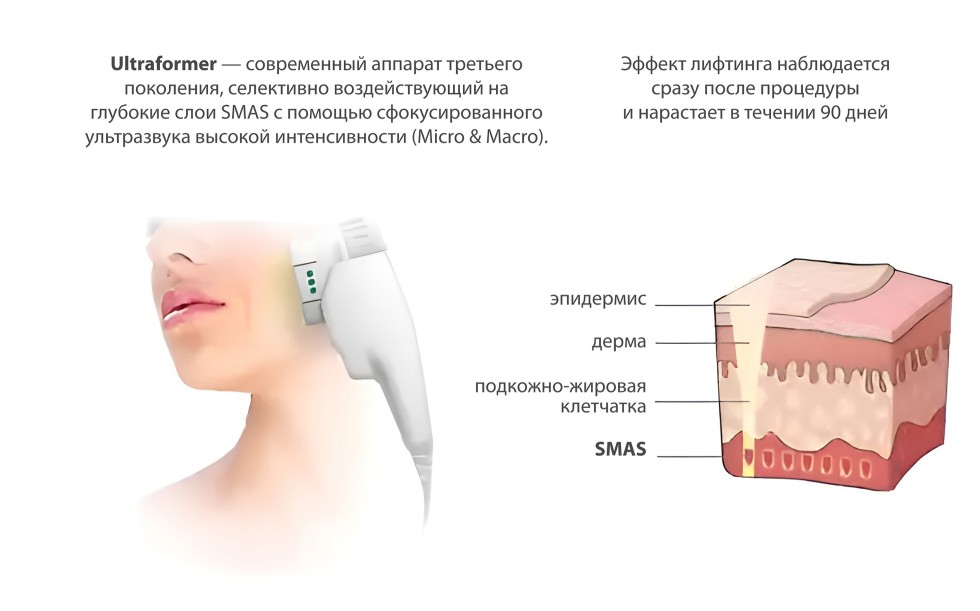 Ультразвуковой SMAS-лифтинг Ultraformer (Ультраформер)