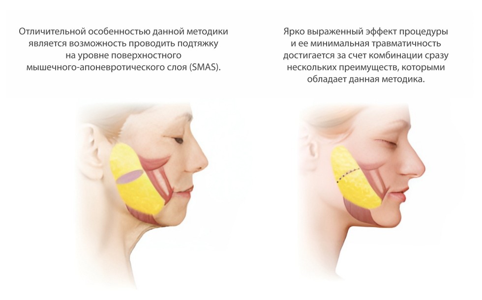 Нитевой Лифтинг