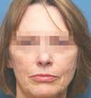 Ulthera System до | пациент 20