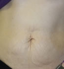 Thermage (Термаж) после | пациент 14