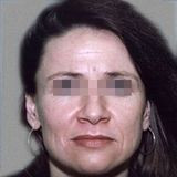 Ulthera System до | пациент 22