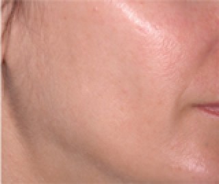 Ulthera System до | пациент 16