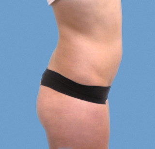 Липосакция после | пациент 39