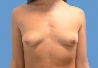 Увеличение молочных желез до | пациент 49