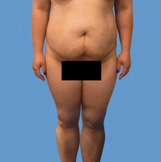 Липосакция до | пациент 29