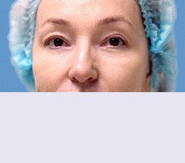 Блефаропластика после | пациент 23