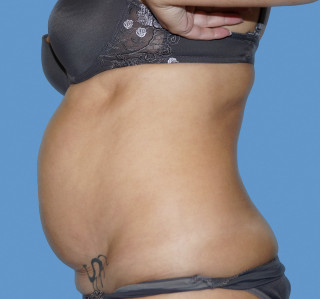 Липосакция до | пациент 34