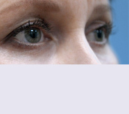 Блефаропластика после | пациент 10