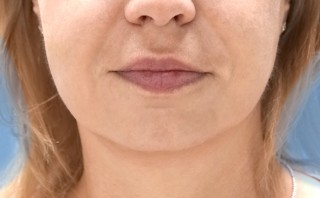 Нитевой Лифтинг после | пациент 26