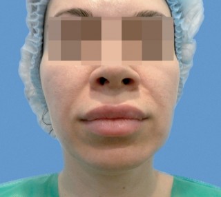 Нитевой Лифтинг до | пациент 21