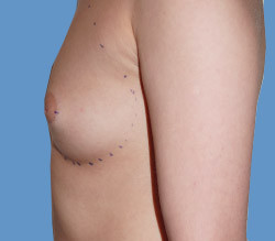 Увеличение молочных желез до | пациент 25