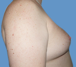 Липосакция до | пациент 20