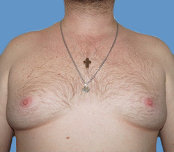 Липосакция до | пациент 18