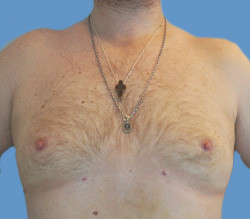 Липосакция после | пациент 18