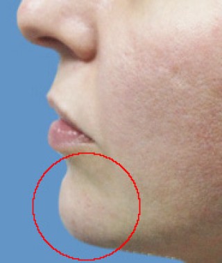 Контурная пластика после | пациент 136