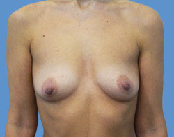 Увеличение молочных желез до | пациент 20