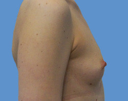 Увеличение молочных желез до | пациент 14