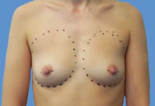 Увеличение молочных желез до | пациент 5