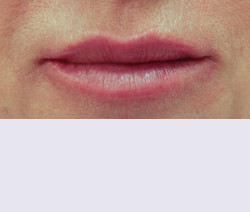 Контурная пластика после | пациент 127