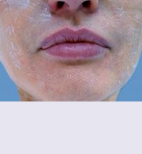 Контурная пластика после | пациент 146