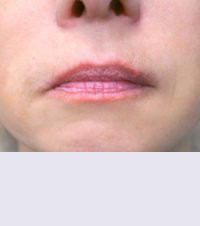 Контурная пластика до | пациент 148