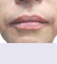 Контурная пластика после | пациент 148