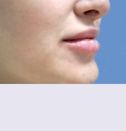 Контурная пластика после | пациент 121