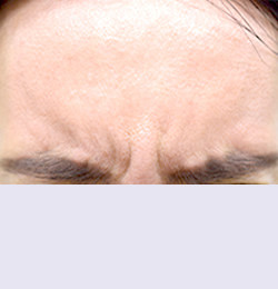 Ботокс до | пациент 13