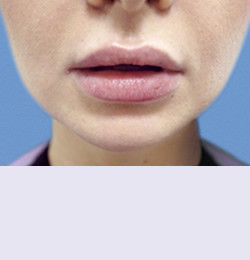 Контурная пластика после | пациент 107