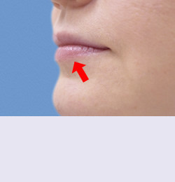 Контурная пластика до | пациент 104