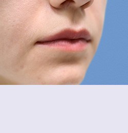 Контурная пластика до | пациент 102