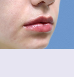 Контурная пластика после | пациент 102