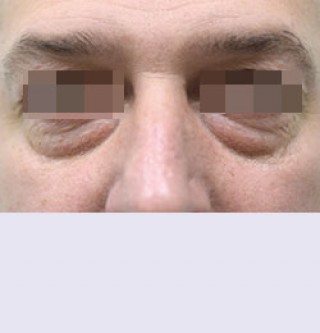 Блефаропластика до | пациент 2
